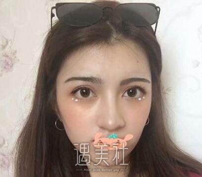 西安,潘勇,双眼皮