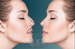 长治市天成整形医院做隆鼻多少钱?会不会很贵? width=