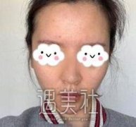 郑东学做鼻子怎么样|郑东学隆鼻案例硬核来袭~ width=