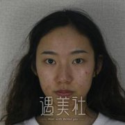 省二院张卓男修复双眼皮有人做过吗？近期案例有没有？ width=