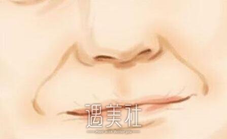 自体脂肪填充法令纹