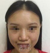 假体隆鼻15天后恢复图|假体隆鼻术后半个月记录~ width=