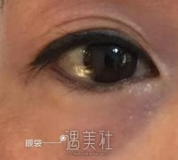 九院的濮哲铭去眼袋怎么样？想看看案例~ width=