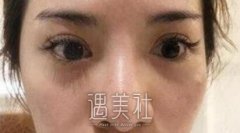 巫文云鼻子案例：终于见识巫医生精湛技术！ width=