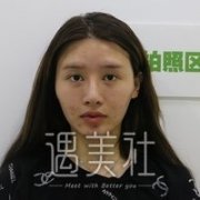 蔡仁祥双眼皮案例分享，恢复果图展示~ width=
