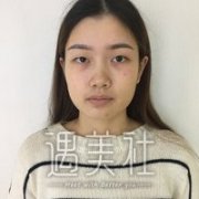 郑大二附院刘月丽双眼皮案例展示，果真自然~ width=