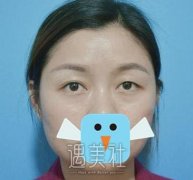 杨亚益双眼皮修复案例恢复过程，眼睛有救了！ width=