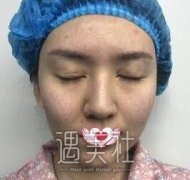 崔永言修复双眼皮案例：修复后的双眼很有神~ width=