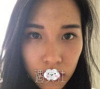 华西卿勇鼻部手术案例：一个月就可以邂逅美丽！ width=