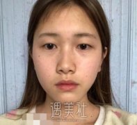 九院苏薇洁案例 朋友都说这双眼皮割的很自然 width=