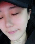 薛峰双眼皮全切案例术前术后对比：山东省立医院美容科价目表 width=
