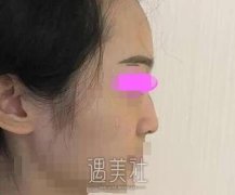 上海美立方任天平案例隆鼻，术后三个月果图 width=