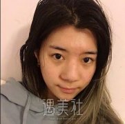 苏州常春藤整形医院价目表：杨国正隆鼻99天恢复过程图 width=