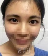 沈阳医大黄威做双眼皮怎么样?有真实的案例吗? width=