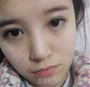 高柳进医生隆鼻案例流出|技术的完全诠释 width=