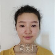 长沙湘雅三医院美容科价目表：龙剑虹全切双眼皮案例恢复过程分享~ width=