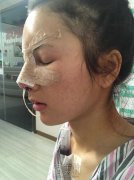 刘云忠鼻子案例：是俺想要的亚子~ width=