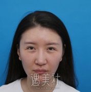 美域高李自银修复双眼皮怎么样?有案例吗? width=