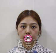 九院袁捷隆鼻案例：一个月的恢复日记~ width=