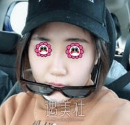 华西郭祥文隆鼻案例分享，术后果超赞！ width=