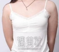 张立彬脂肪丰胸案例图，记录恢复全过程~ width=