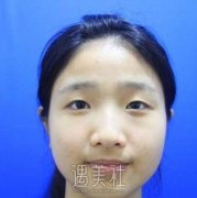 李高峰双眼皮技术好吗？有案例吗？ width=