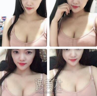 李发成脂肪隆胸案例 瘦子还胸大就是我 width=