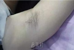 昆山百达丽整形医院脱毛案例分享，致摆脱腋毛的我! width=