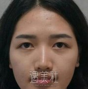 重医附一院割双眼皮哪个医生好?求推荐~ width=