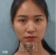 中国医大一院黄威隆鼻价格+案例分享~ width=