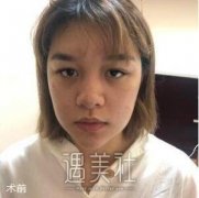 上海第九人民医院缩小鼻翼案例分享~ width=