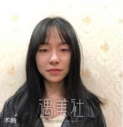 杭州艺星王光建双眼皮案例分享~ width=