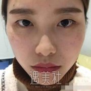 淄博中心医院割双眼皮怎么样?有真实案例吗? width=