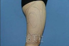 成都李烈吸脂案例：身材这就变好了噻~ width=