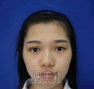 北医三院安阳隆鼻案例分享一波~ width=