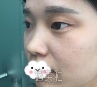 协和杨杰双眼皮案例：这眼睛是温柔的味道！ width=