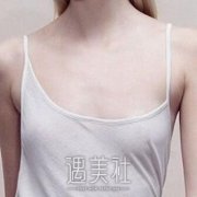 上海九院王涛隆胸案例：大胸不再是梦！ width=