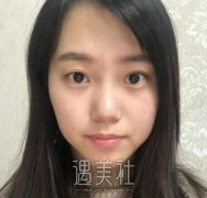徐晓斐双眼皮修复的怎么样？有案例吗？ width=