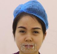 华西李正勇隆鼻案例，这变化让我年轻十岁！ width=