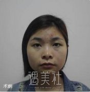 华西医院隆鼻多少钱？华西李正勇隆鼻案例+价格表分享 width=