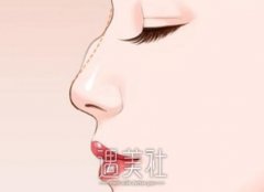梧州矫正驼峰鼻手术多少钱？ width=