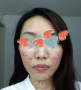 大连医大二院整形科点阵激光怎么样?痤疮疤痕的克星! width=