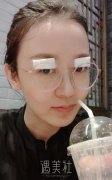 杜园园双眼皮修复案例：终于拥有大眼睛! width=