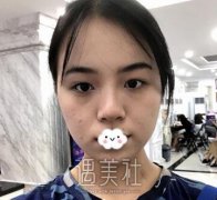 西京潘勇做双眼皮案例：这果出奇的好啊！ width=
