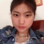 深圳北大医院瘦脸案例展示，气质瞬间提升! width=