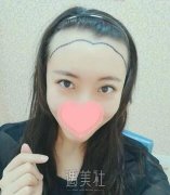济南海峡医院植发怎么样?我想拥有正常的发际线! width=