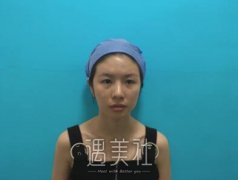 穆雄铮磨骨案例：大手术还是得找正规机构! width=