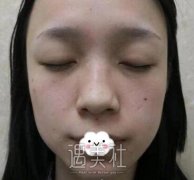 上海周双白隆鼻案例，做完隆鼻后美炸了！ width=