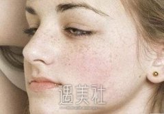 广州镭射祛斑一般多少钱？ width=