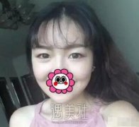 八大处赵延勇双眼皮案例展示|果真自然! width=